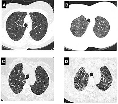 Hypersensitivity Pneumonitis: Diagnostic and Therapeutic Challenges